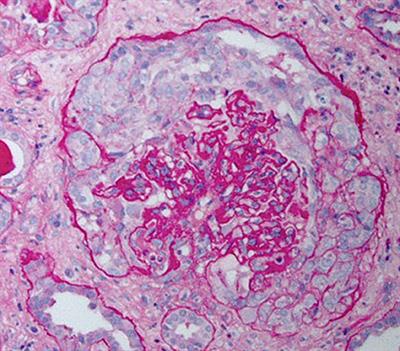 Molecular Mechanisms of Injury in HIV-Associated Nephropathy